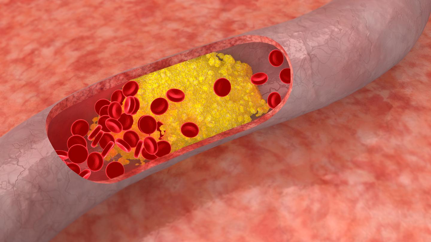 Colesterol LDL